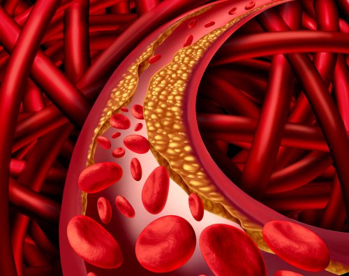 un eccesso di colesterolo può portare a soffrire di patologie coronariche