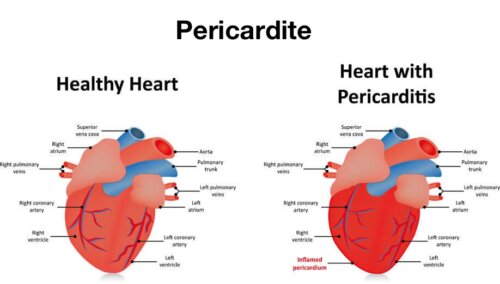 Fitte al cuore: pericardite