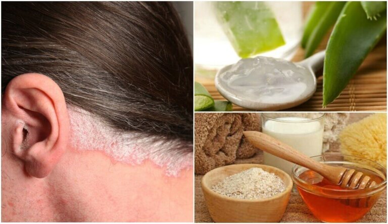 Psoriasi del cuoio capelluto: 5 rimedi naturali