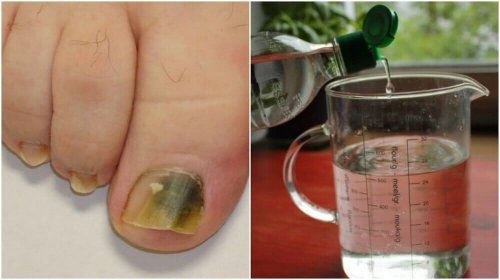 Micosi alle unghie: ricetta a base di alcol per combatterla