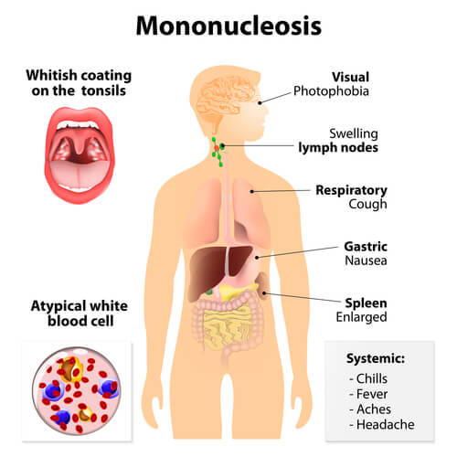 Sintomi della mononucleosi