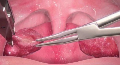 Estrazione delle tonsille