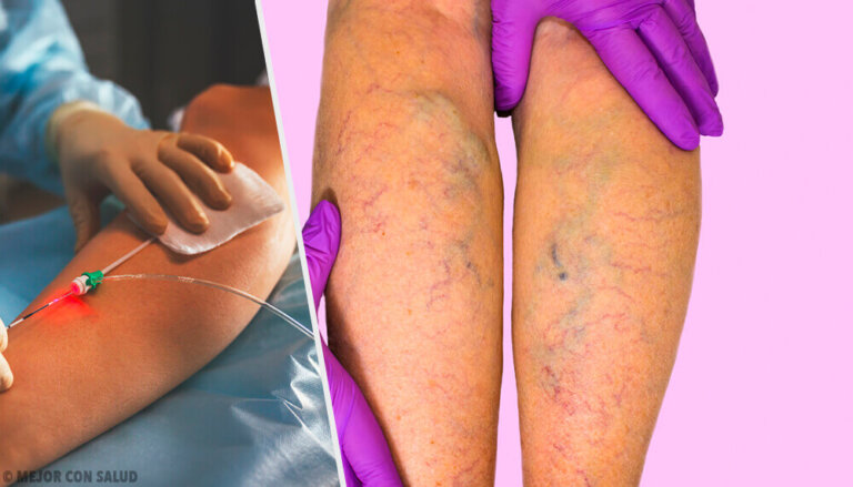 Malattia varicosa: sintomi, cause, diagnosi e terapia