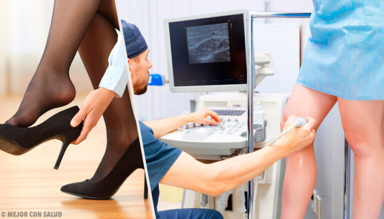 Vene varicose: 3 rimedi naturali