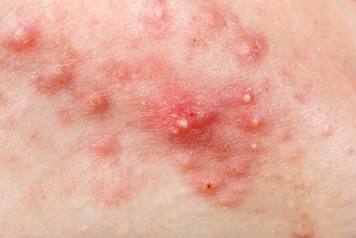 Brufoli sul sedere: perché compaiono?