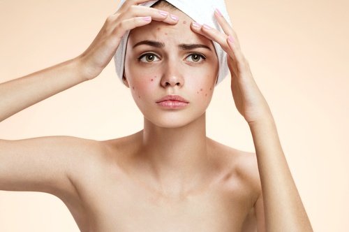 Maschera contro l'acne