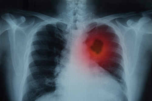 Cancro del polmone