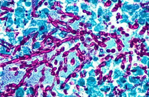 Candidosi vaginale batteri - infezioni intime