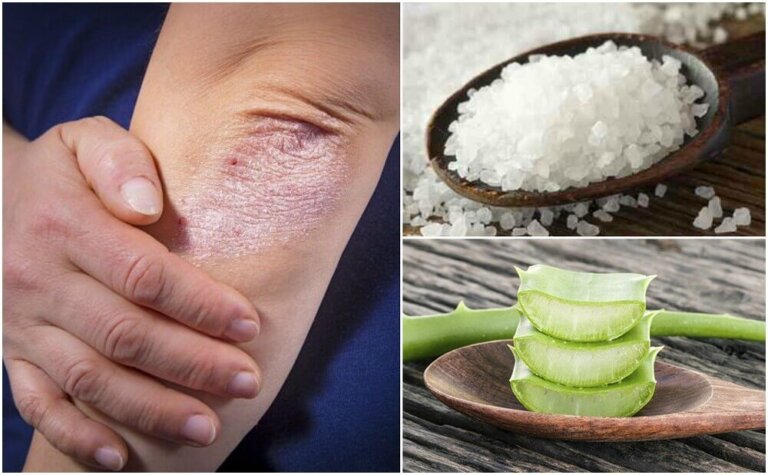 Micosi della pelle: 5 soluzioni naturali