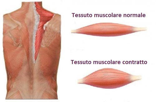 Contrattura muscolare