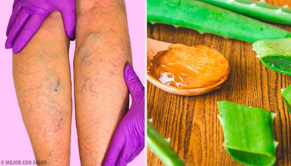 Curare le vene varicose con un rimedio all’aloe vera Curare le vene varicose con un rimedio all’aloe vera
