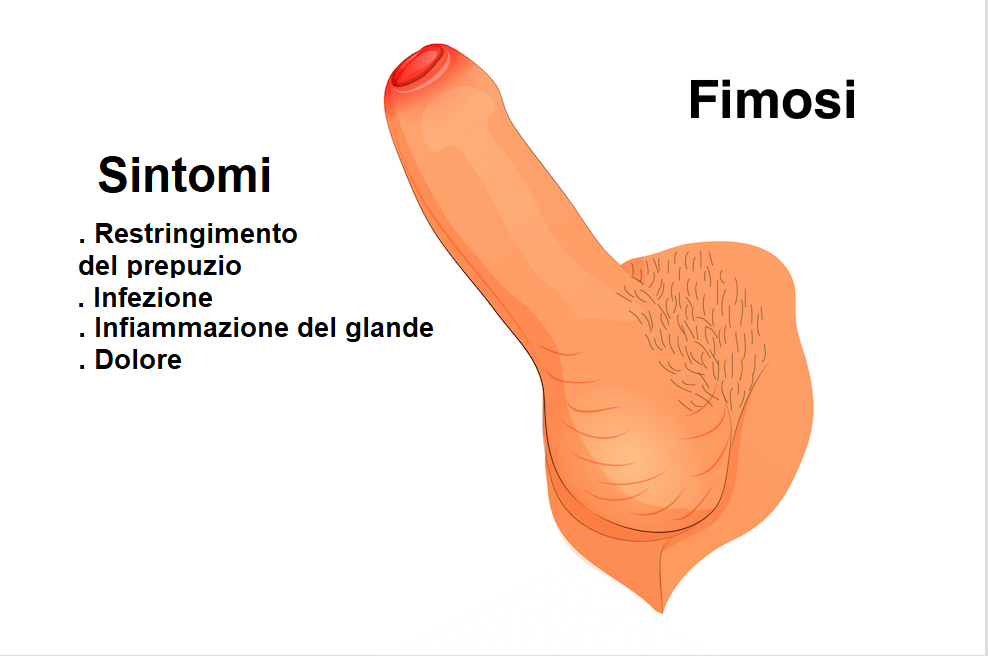 Riduzione delle dimensioni del pene - Cause e Sintomi