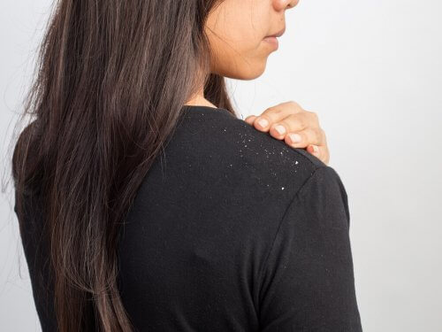 shampoo fai da te per la forfora