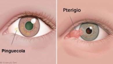 Malattie degli occhi: pinguecola e pterigio