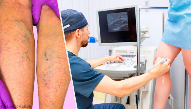 Prevenire e trattare le varici: trattamenti topici e orali