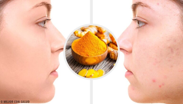 Eliminare le cicatrici da acne con 5 maschere alla curcuma