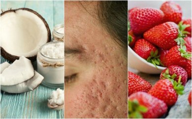 Attenuare le cicatrici dell'acne con trattamenti naturali