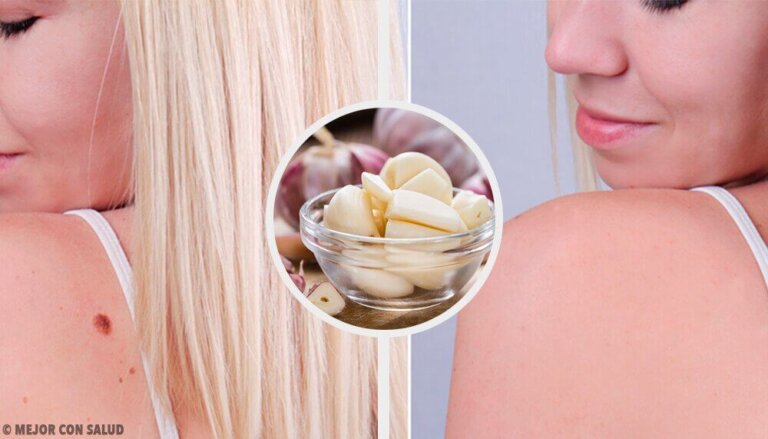 9 modi per rimuovere rapidamente le verruche