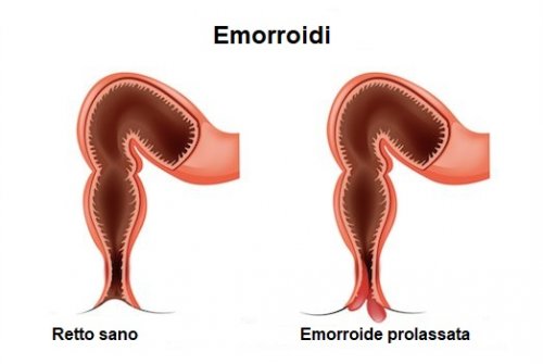 Schema emorroidi