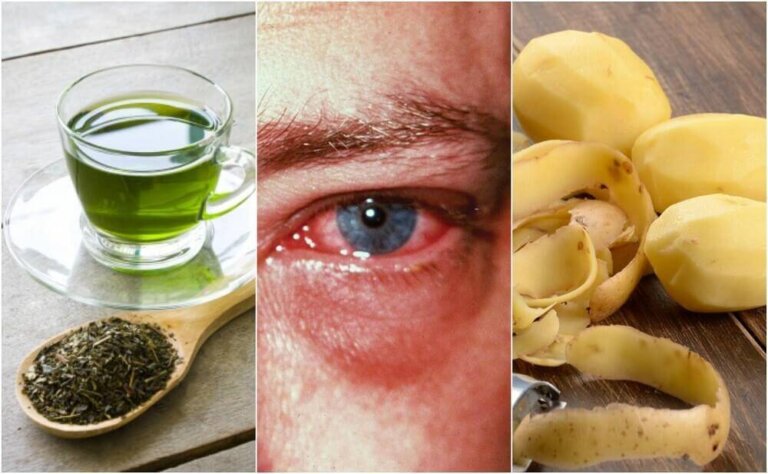 Curare la congiuntivite con rimedi naturali