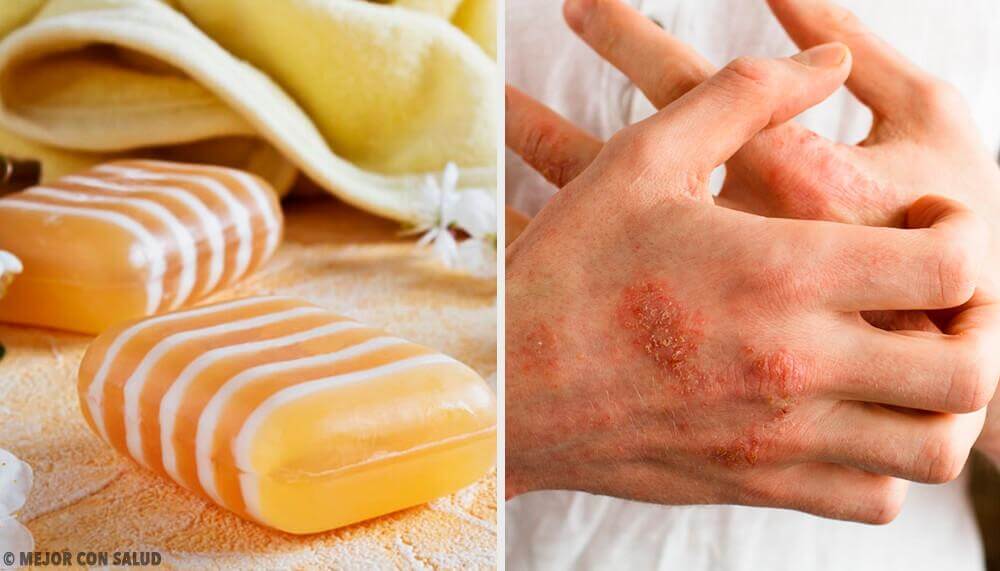 Sapone per la dermatite con propoli e argilla Sapone per la dermatite con propoli e argilla