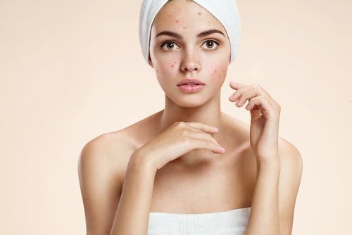 Maschera contro l'acne
