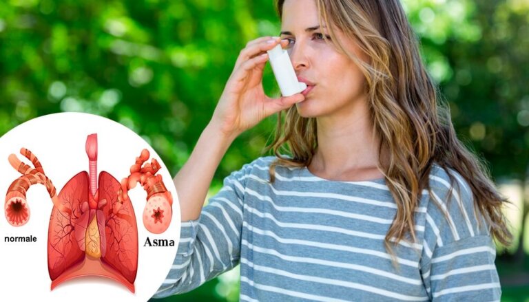 Asma: cause, sintomi e diagnosi