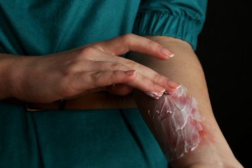 Bruciatura al braccio con crema