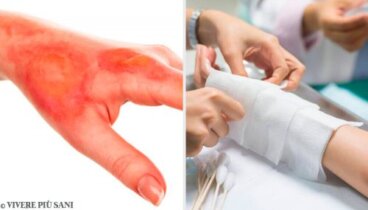 Bruciature, sapete cosa fare e come reagire?