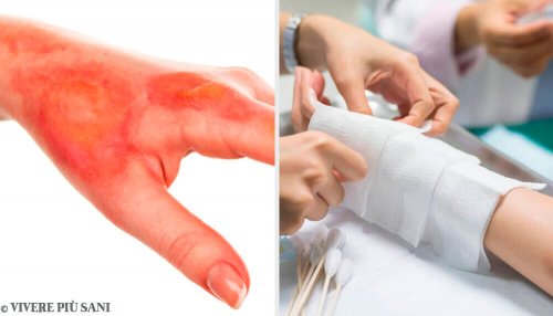 Bruciature, sapete cosa fare e come reagire?
