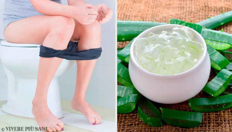 Rimedi per le emorroidi facili e naturali