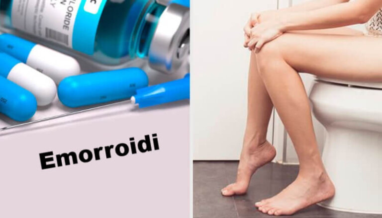 Come trattare le emorroidi