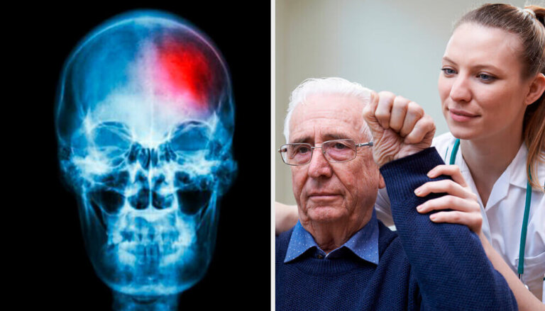 Mini-ictus cerebrale: cos'è e come riconoscerlo