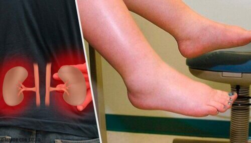 Perché soffriamo di ritenzione idrica?