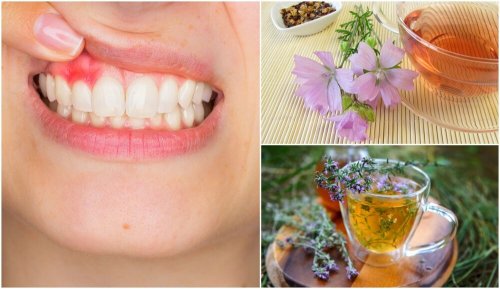 Sintomi della gengivite: soluzioni naturali per alleviarli