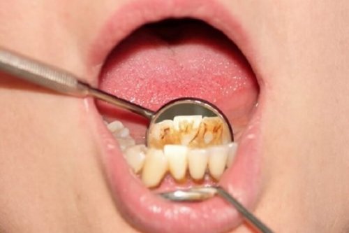 Tartaro sulla parete interna dei denti