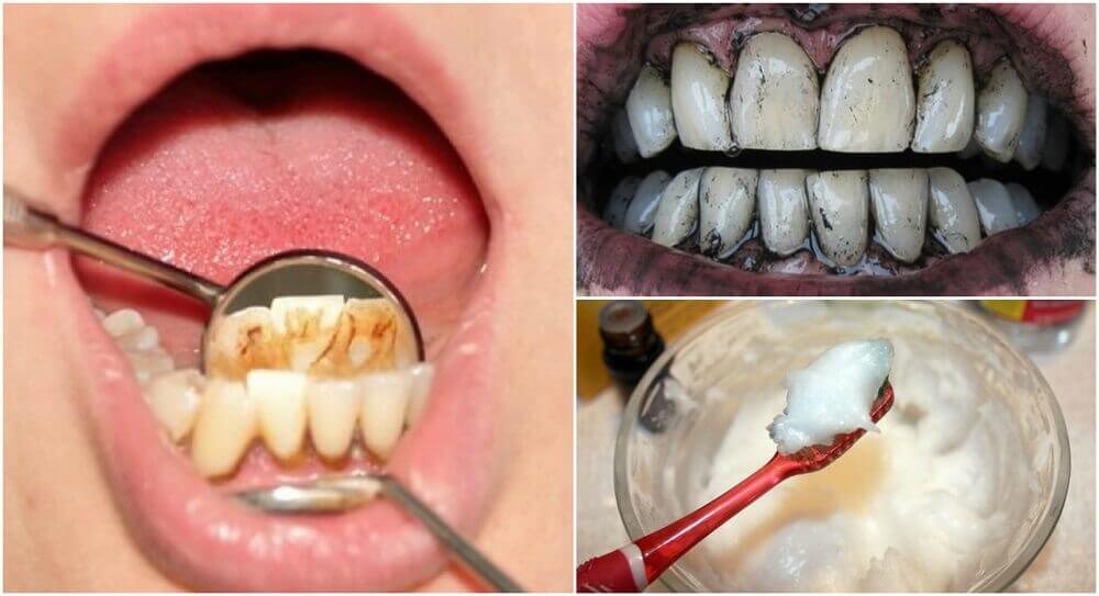 Tartaro nei denti: rimedi naturali per rimuoverlo Tartaro nei denti: rimedi naturali per rimuoverlo