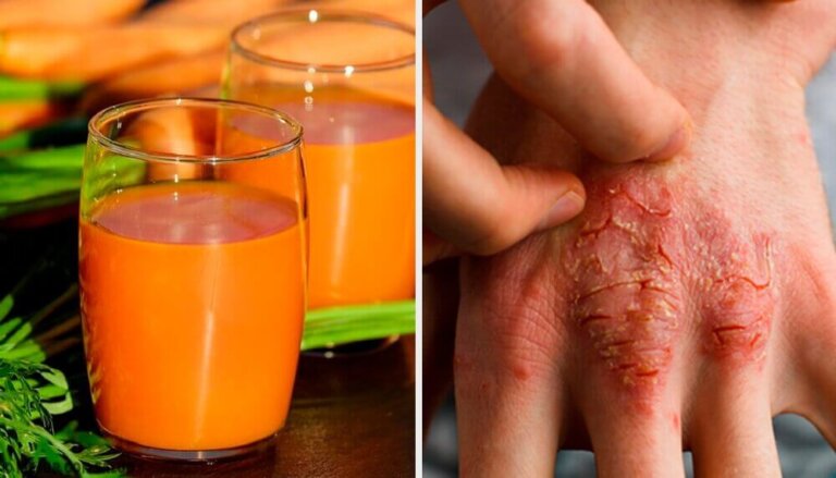 Prevenire e curare la psoriasi: rimedi naturali