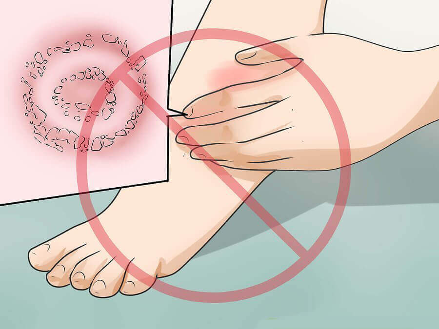 Erisipela: cause, sintomi e trattamento Erisipela: cause, sintomi e trattamento