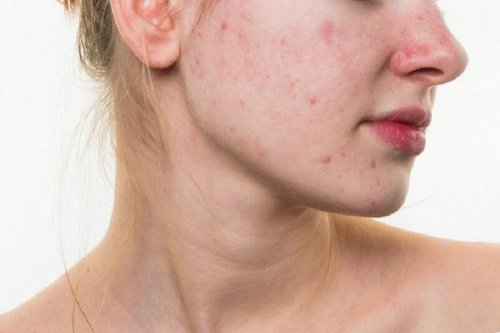 Donna con acne