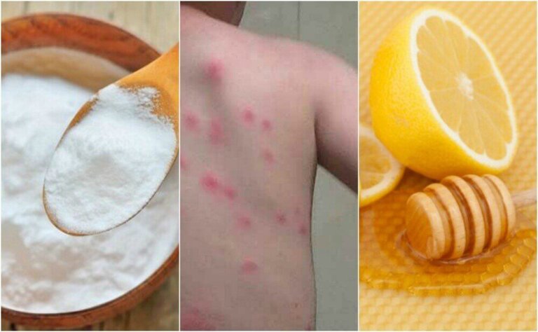 Punture delle pulci: 5 rimedi naturali