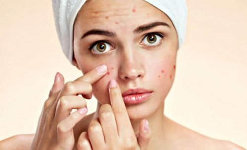 Segnali sul viso: ragazza con acne.