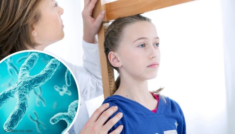 La sindrome di Turner: sintomi e trattamento