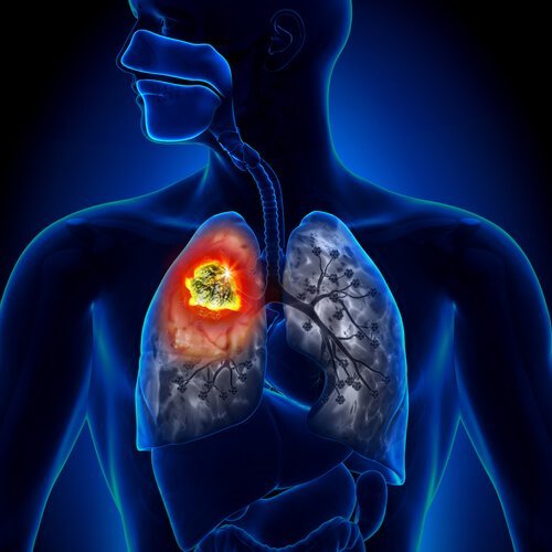 Cancro ai polmoni
