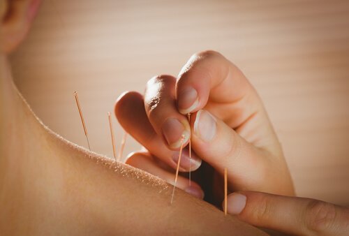Trattamento di agopuntura