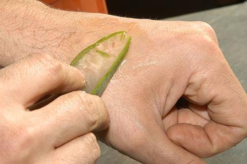 Aloe vera e le scottature