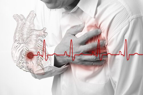 Infarto miocardico acuto: di cosa si tratta?