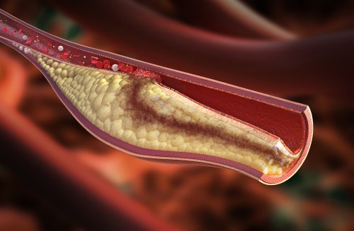 Colesterolo nelle arterie