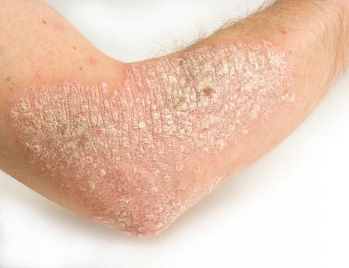 psoriasi sul gomito