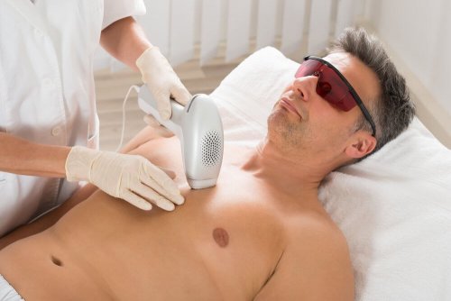 Depilazione laser uomo